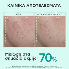 Apivita Just Bee Clear Serum Ορός Λείανσης για Ατέλειες & Σημάδια Ακμής, 30ml