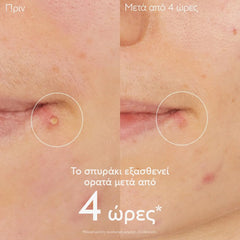 Caudalie Vinopure Salicylic Spot Solution Kρέμα Τοπικής Εφαρμογής για Σπυράκια, 15ml