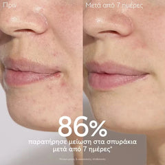Caudalie Promo Vinopure Blemish Control Salicylic Serum Ορός Προσώπου κατά των Ατελειών, 30ml & Δώρο Vinopure Purifying Toner Φροντίδα κατά των Ατελειών, 200ml, 1σετ