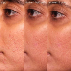 Caudalie Promo Vinopure Blemish Control Salicylic Serum Ορός Προσώπου κατά των Ατελειών, 30ml & Δώρο Vinopure Purifying Toner Φροντίδα κατά των Ατελειών, 200ml, 1σετ