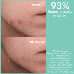 APIVITA JUST BEE CLEAR ΛΟΣΙΟΝ ΣΥΣΦΙΞΗΣ ΠΟΡΩΝ ΕΞΥΓΙΑΙΝΕΙ ΤΟ ΔΕΡΜΑ με propolis AmC & φυτικό σαλικυλικό οξύ